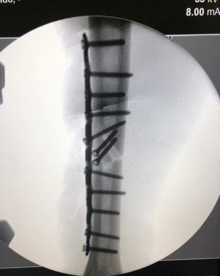 Marquez reveals x-rays of broken arm