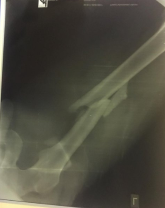 Toby Price reveals details of badly broken leg