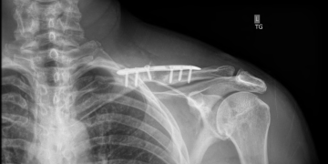 An x-ray of Andrew Houlihan's left clavicle. Image: Supplied